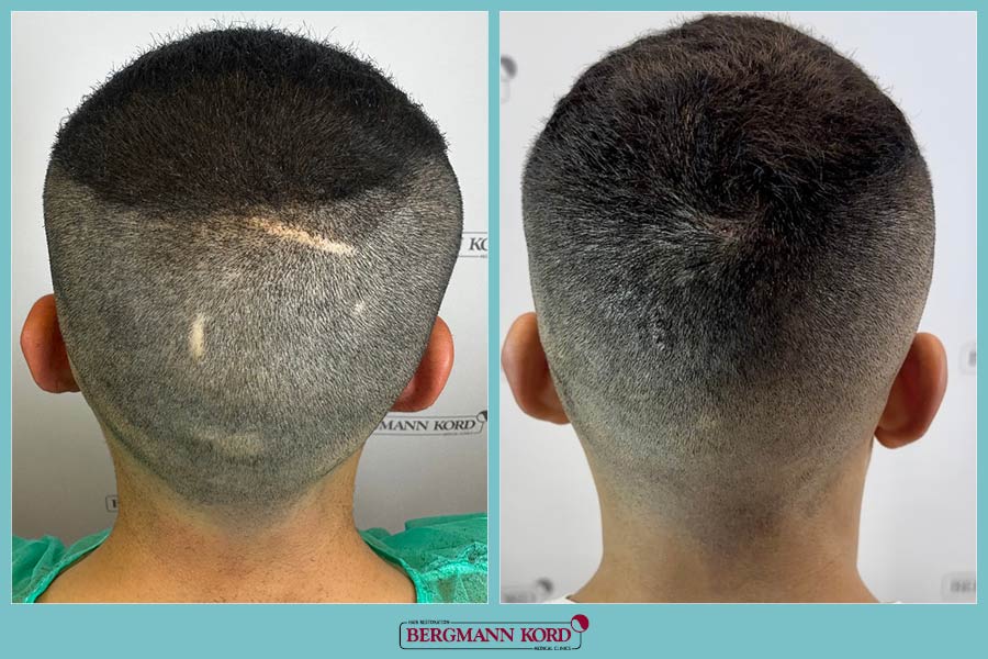 FUE Hair Transplant Case #30691PG