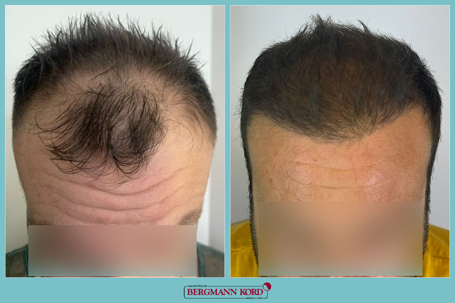 FUE Hair Transplant Case #03049PG