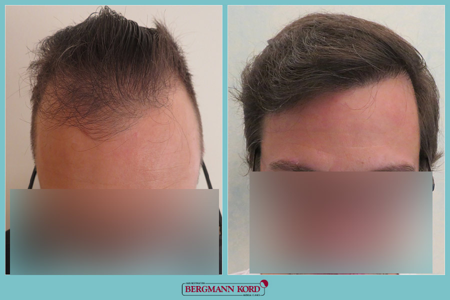 FUE Hair Transplant Case #08670PG